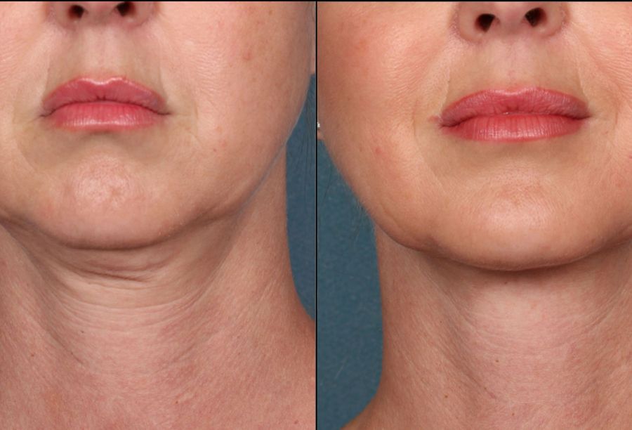 Before / After